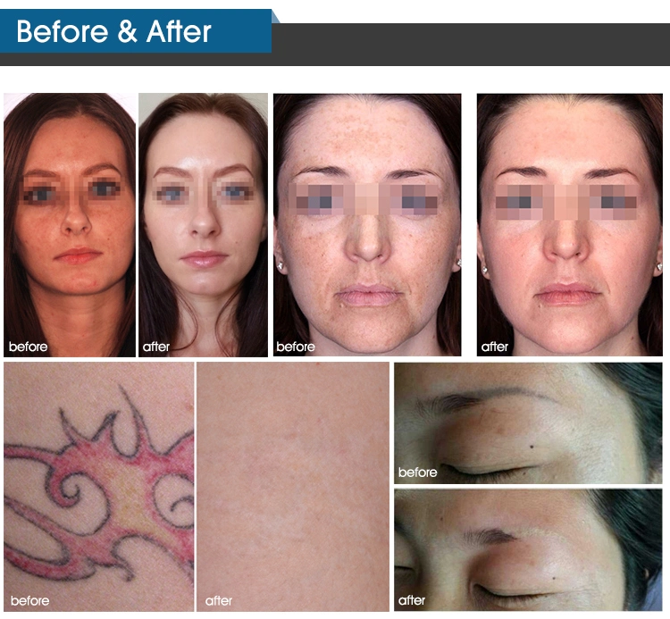 ADSS Picosecond Laser Tattoo Removal Spots Removal Skin Rejuvenation Device