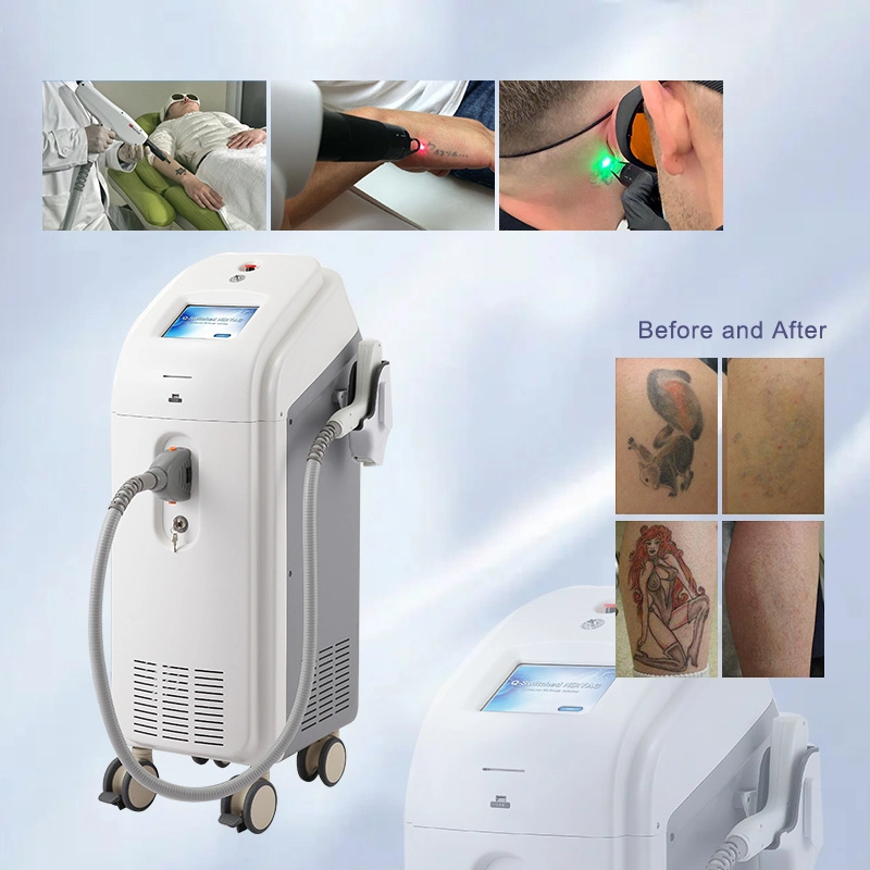 Q Switch Tattoo Removal ND YAG Laser and Also for Mole Removal